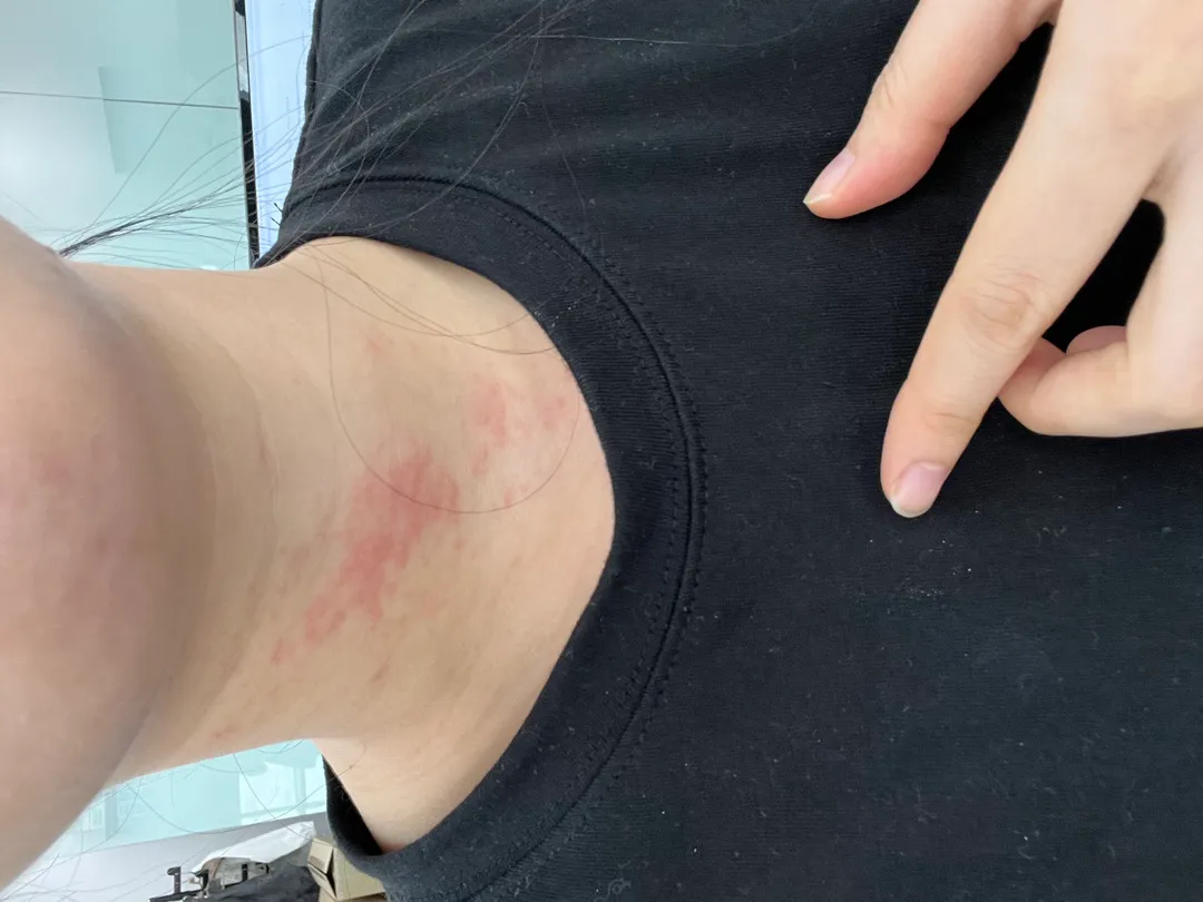 목에도 소양증이 생기나요  😭