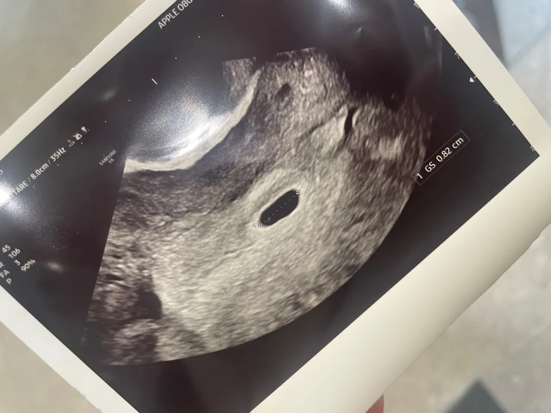 유산 후 무월경 임신!