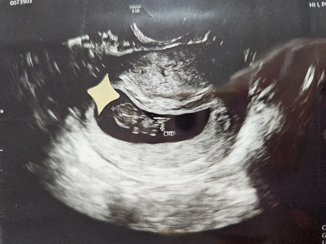 지난주(9주2일) 초음파 다시 보는데 볼때마다 웃음나요 ㅎㅎ
