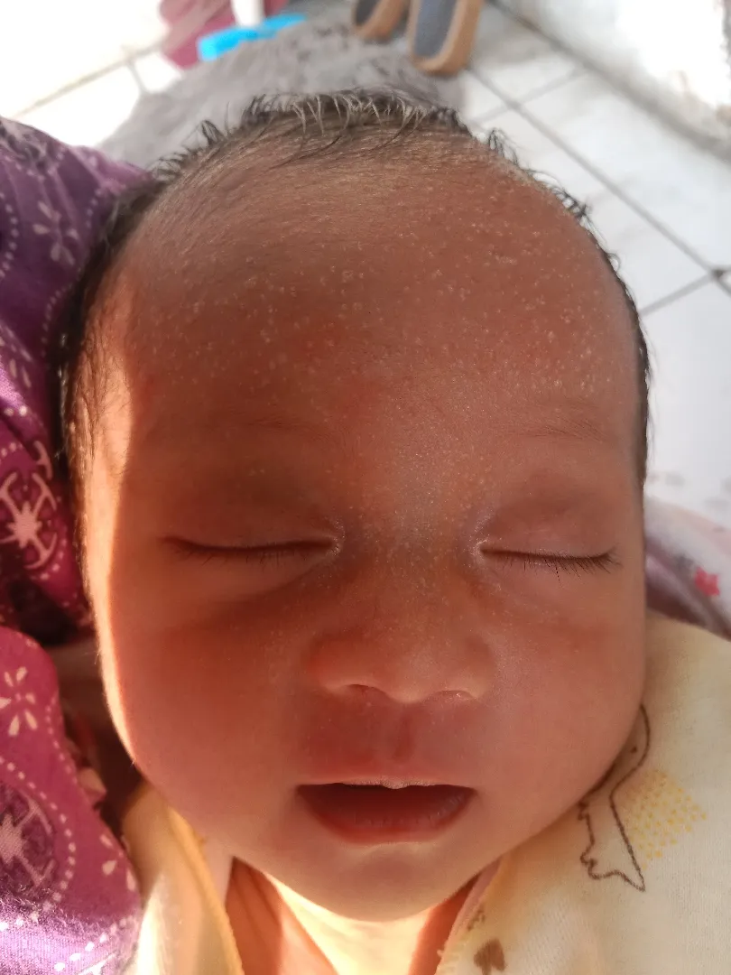 Bruntusan bayi baru lahir 