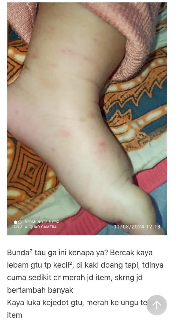 Bercak lebam kecil di kaki