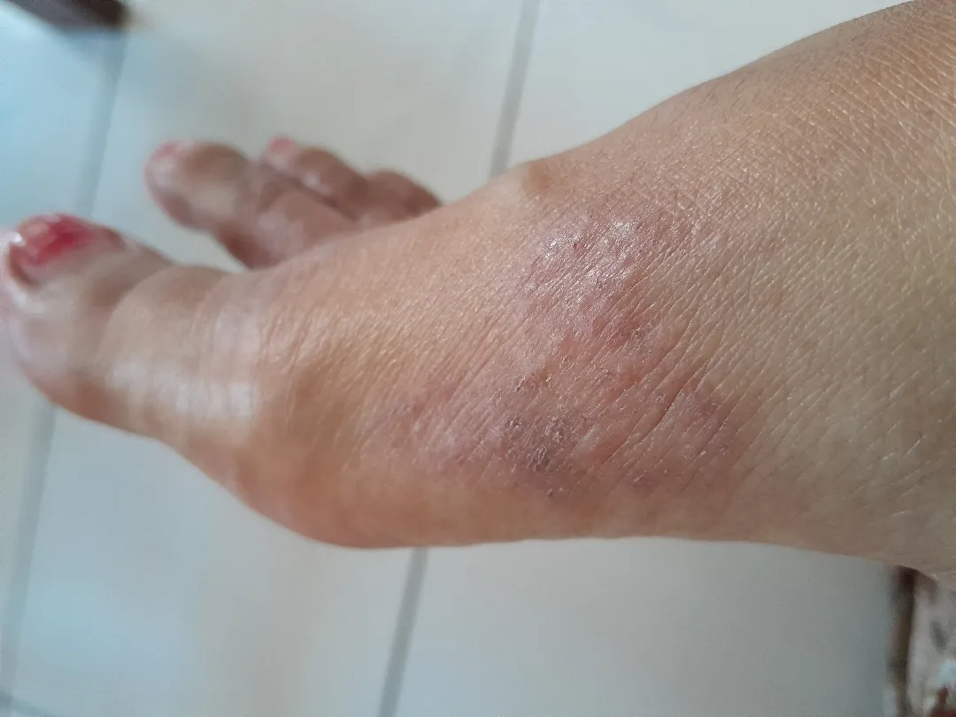 Gatal di kaki