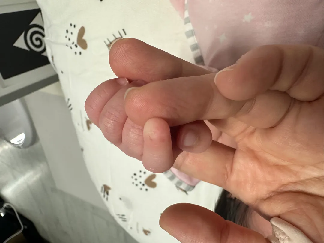 아기 손톱 기형일까요..ㅠ