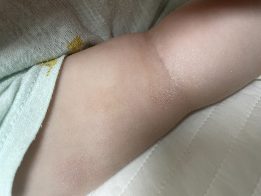 피부 봐주세요 ㅠ