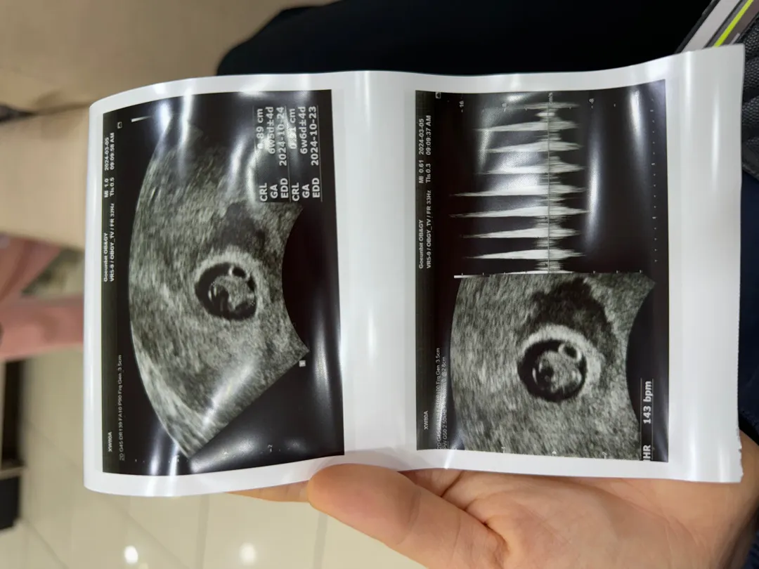 임신 6주 아기집