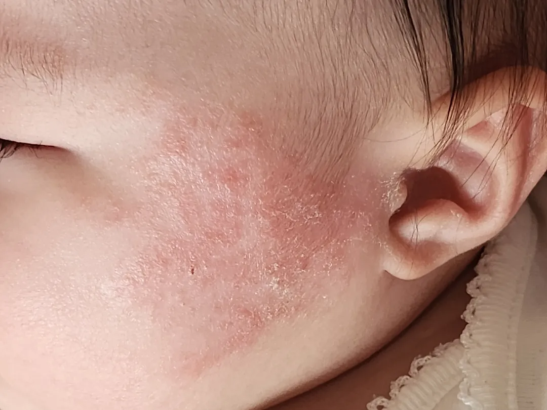 태열인가요?ㅠㅠ