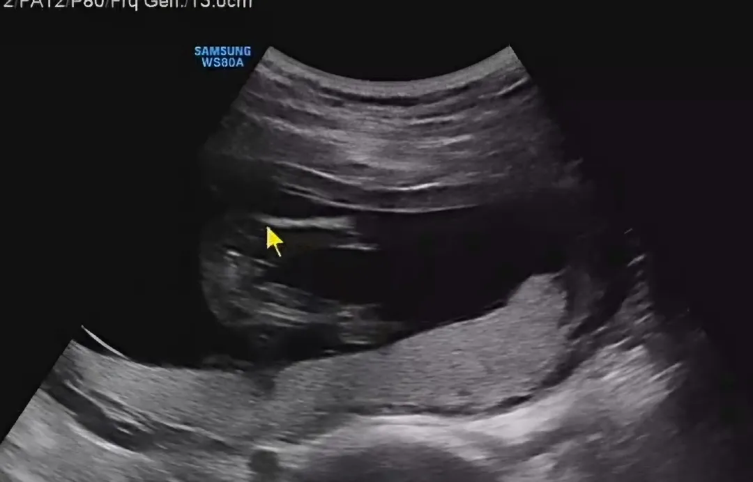 다리사이 초음파👶🏻 성별 뭘로 보이시나요?