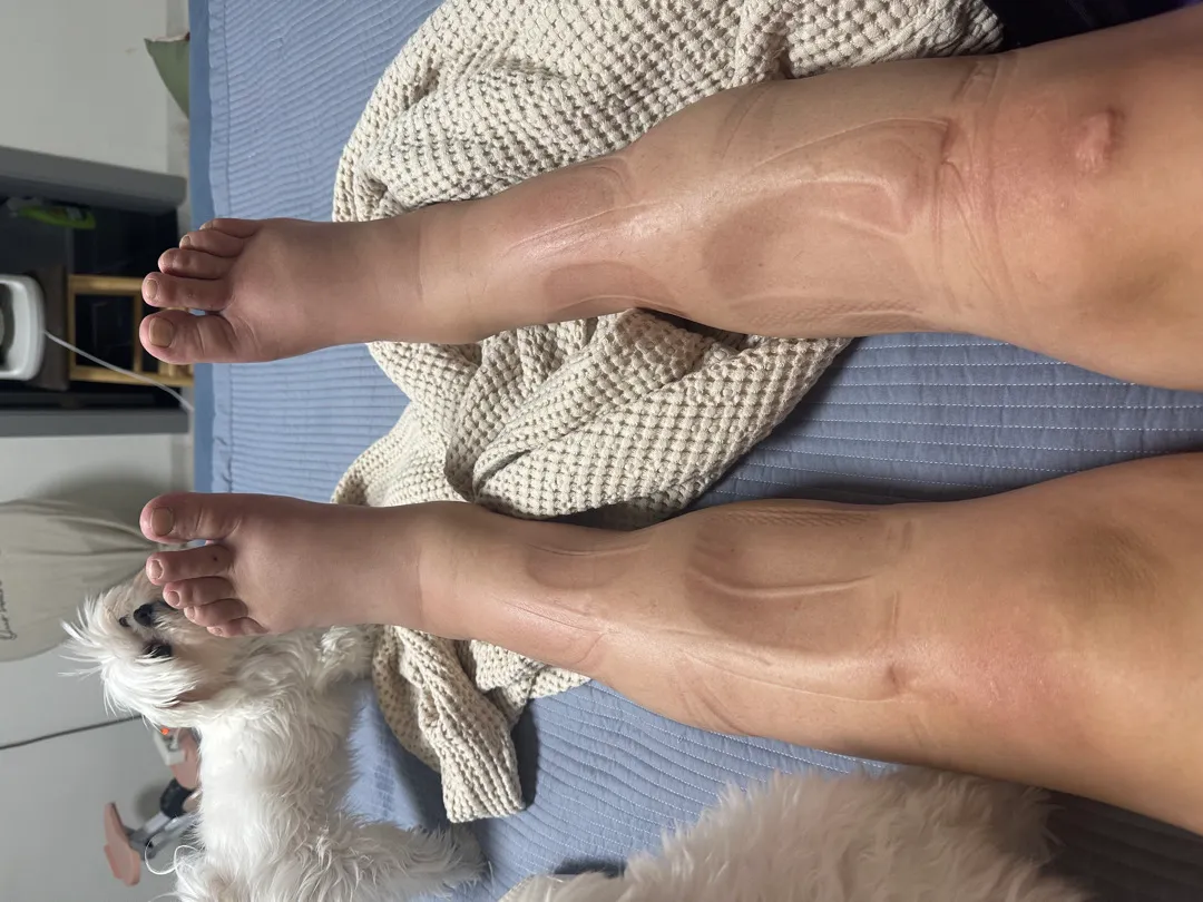 막달 붓기ㅠㅜ
