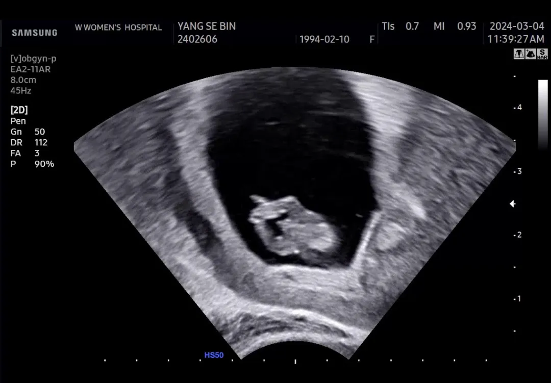 9주차 초음파👶🏻