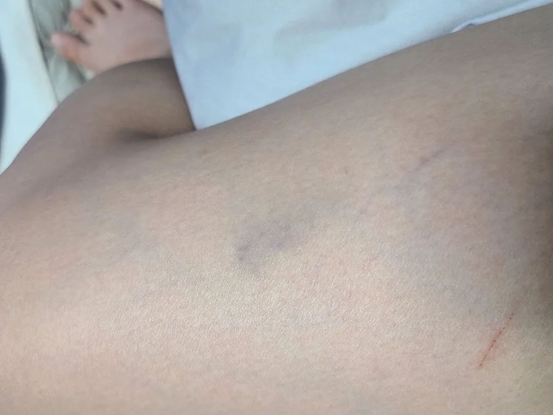 (사진O) 혹시 피부 아래 멍(?)드는분 계세요?