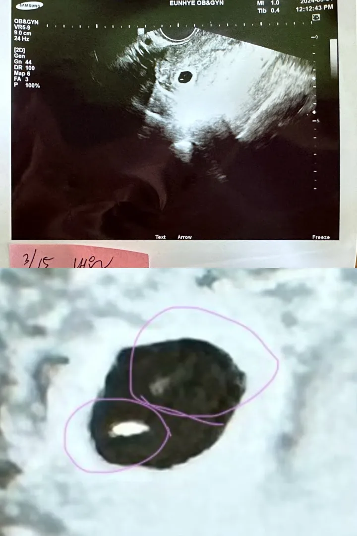 초음파에 이건 뭘까요?