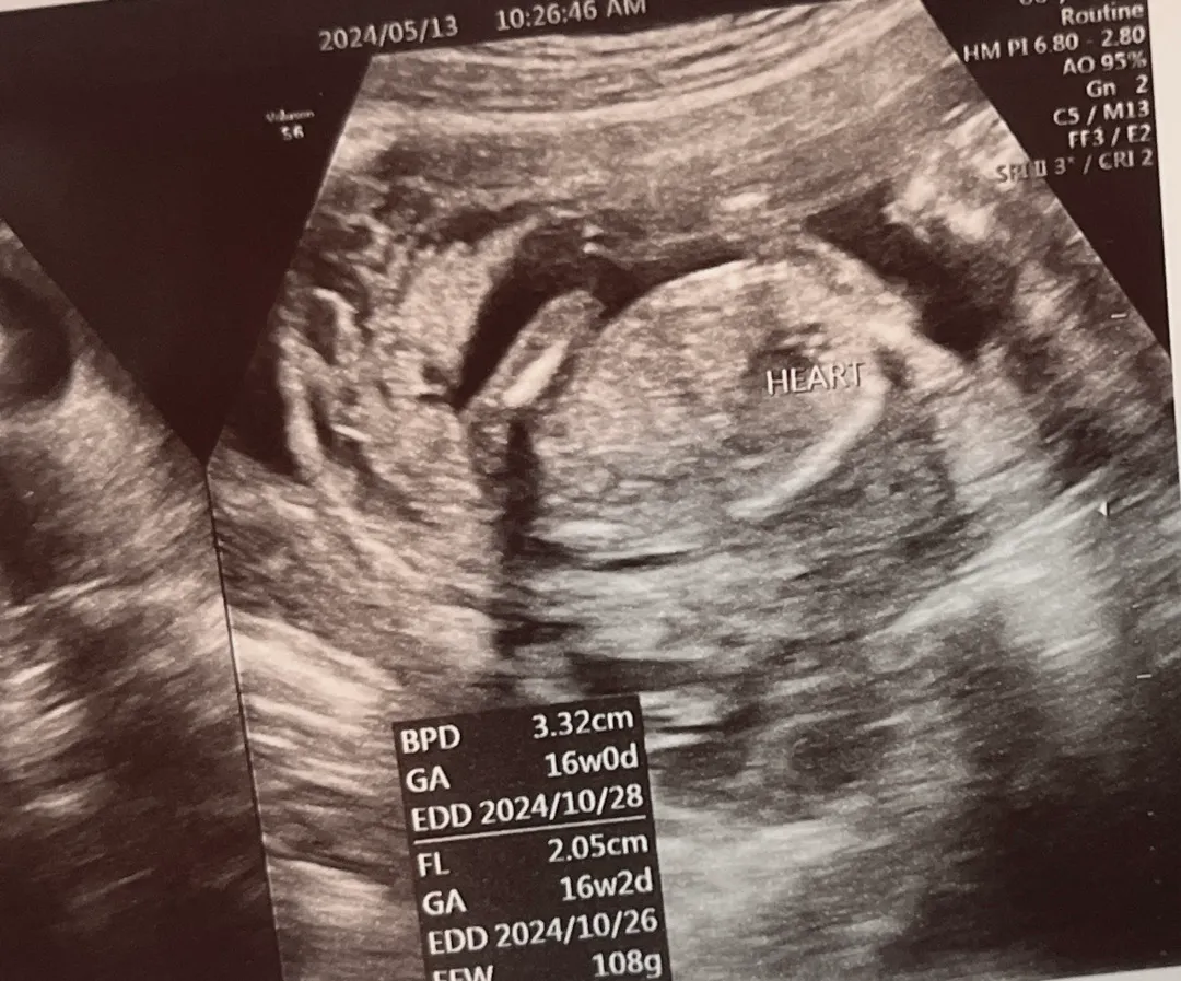 15주 5일 딸맘 확정 👼🏻💓