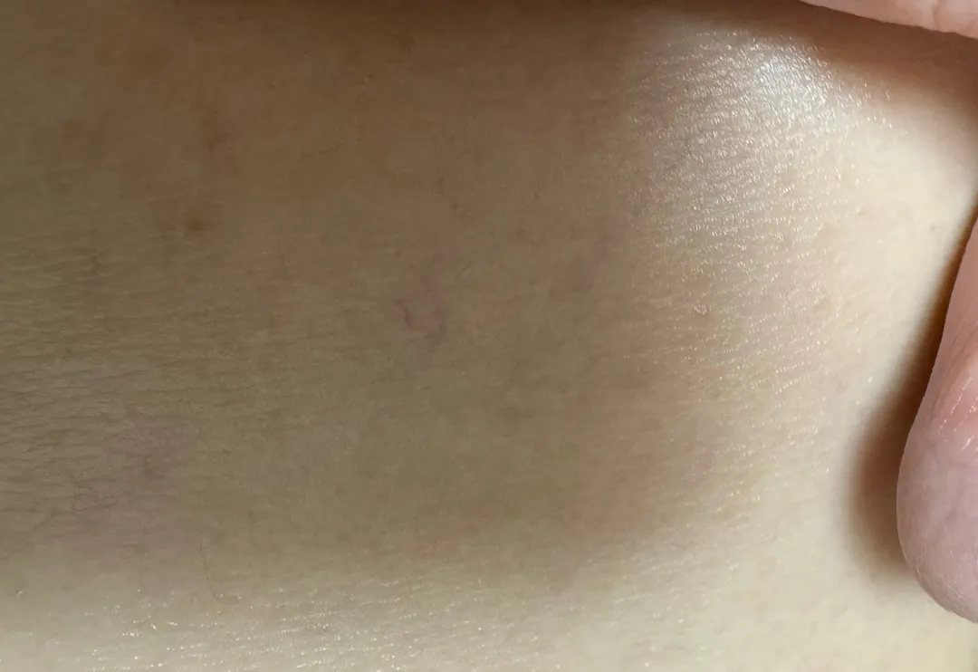 혹시 이거 튼살생기려는건가여? ㅠㅠㅠ