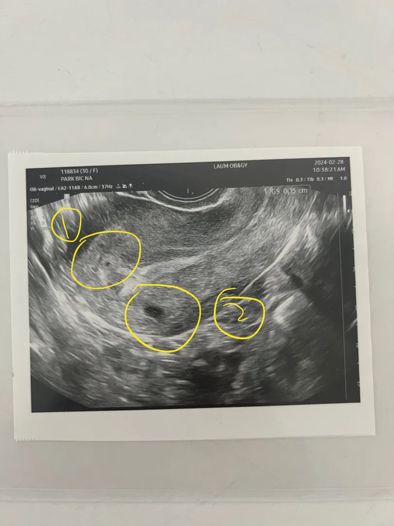 이게 아기집이 맞을까요?