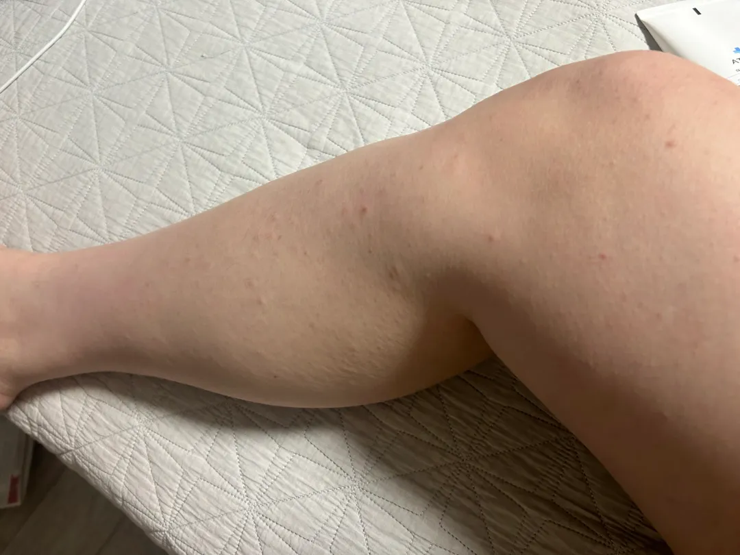 ㅠㅠ소양증 다들 심한가요?