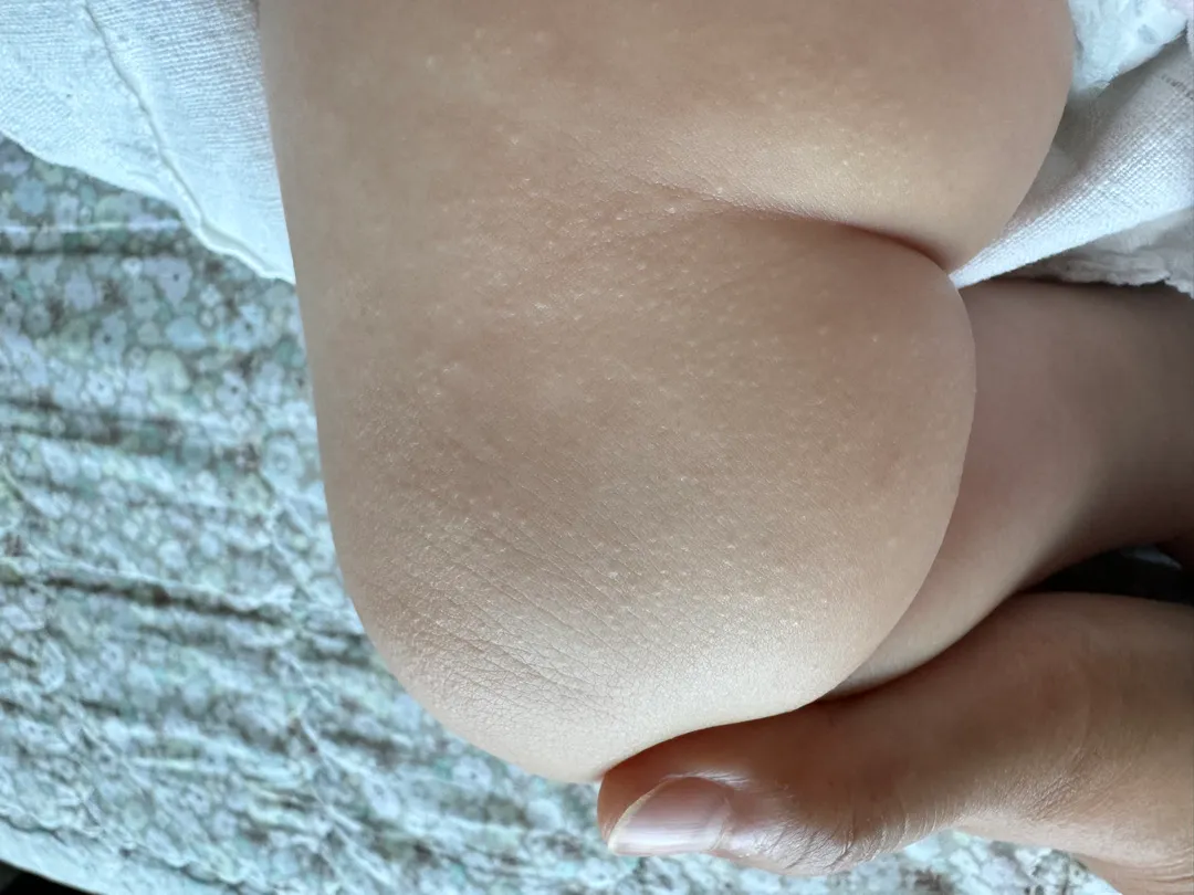 아가 피부가 오돌토돌해요