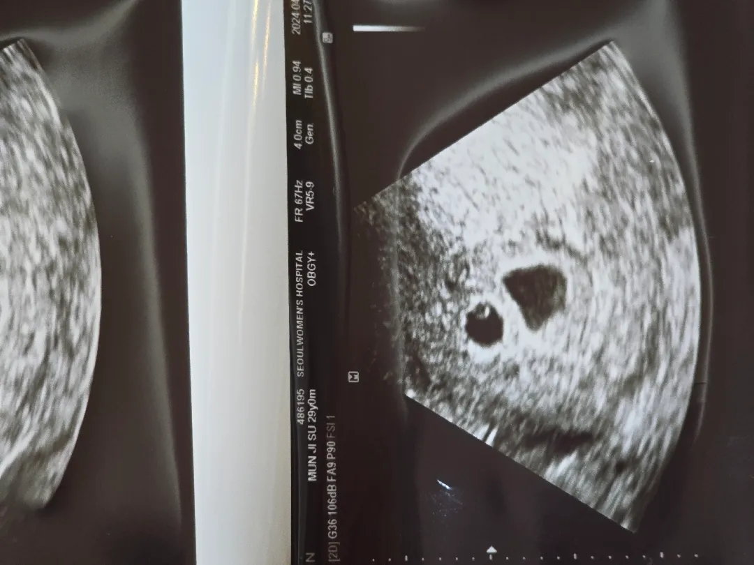 쌍둥이 아기집 보고왔어요♡