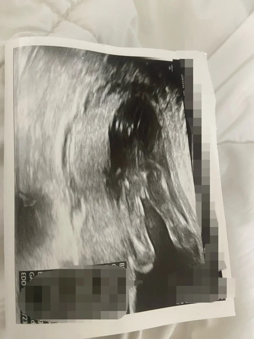 19주 6일 성별반전이 있을까요 ??
