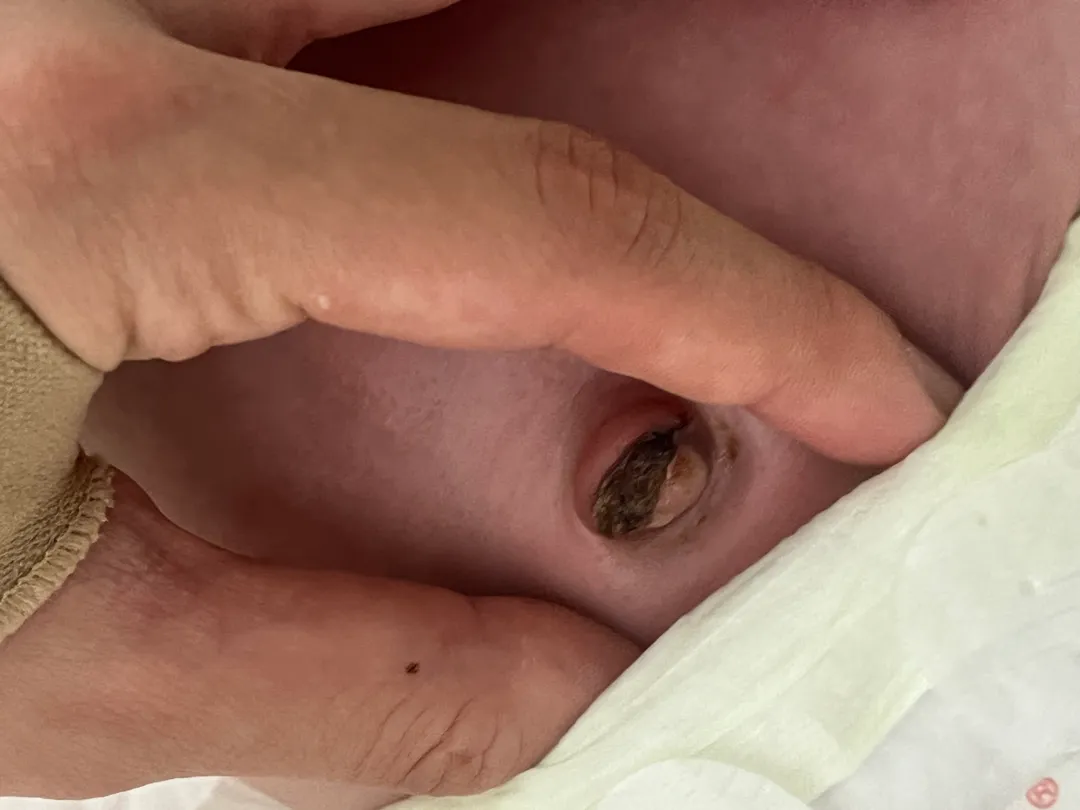 안녕하세요 제대 탈락 후 배꼽 괜찮은건가요?