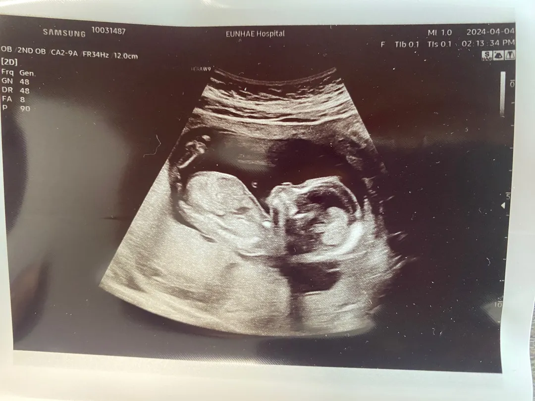 14w4d 초음파쌤은 성별 아직 모른다고ㅜ