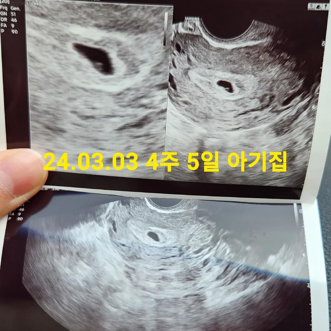 4주5일 아기집,난황