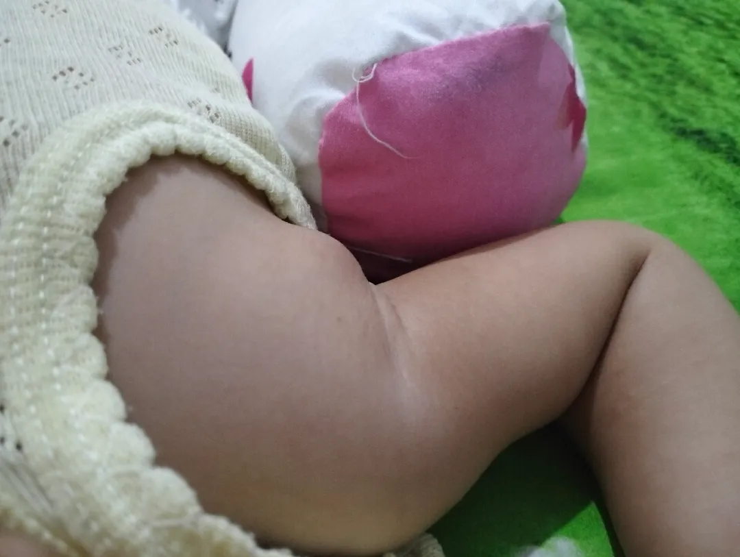 Benjolan di ketiak Bayi