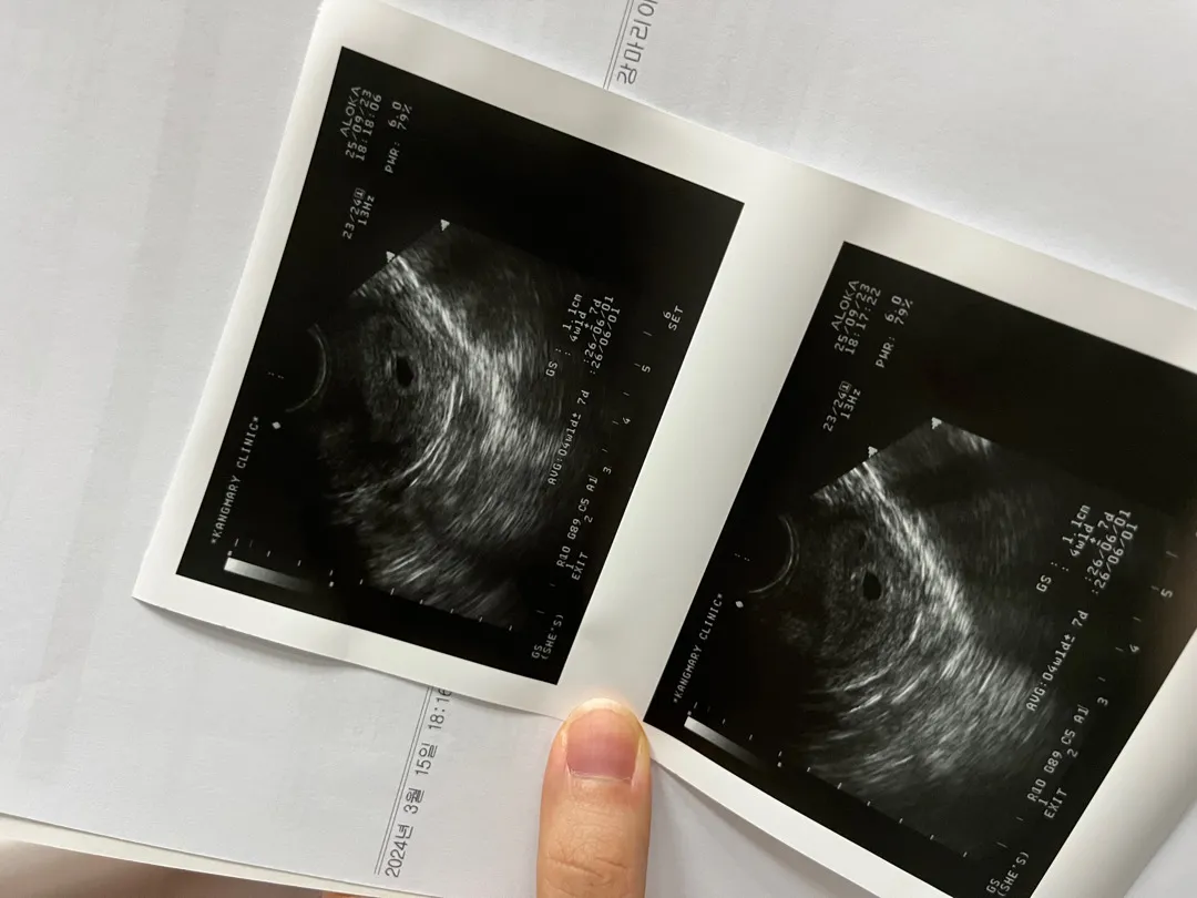 오늘 아기집보고왔어요