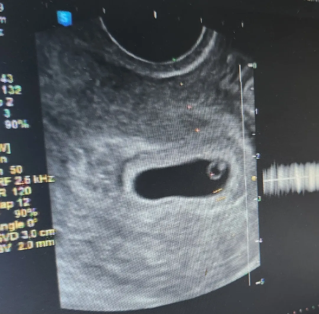아기집 크기 크면 좋은건가요..?