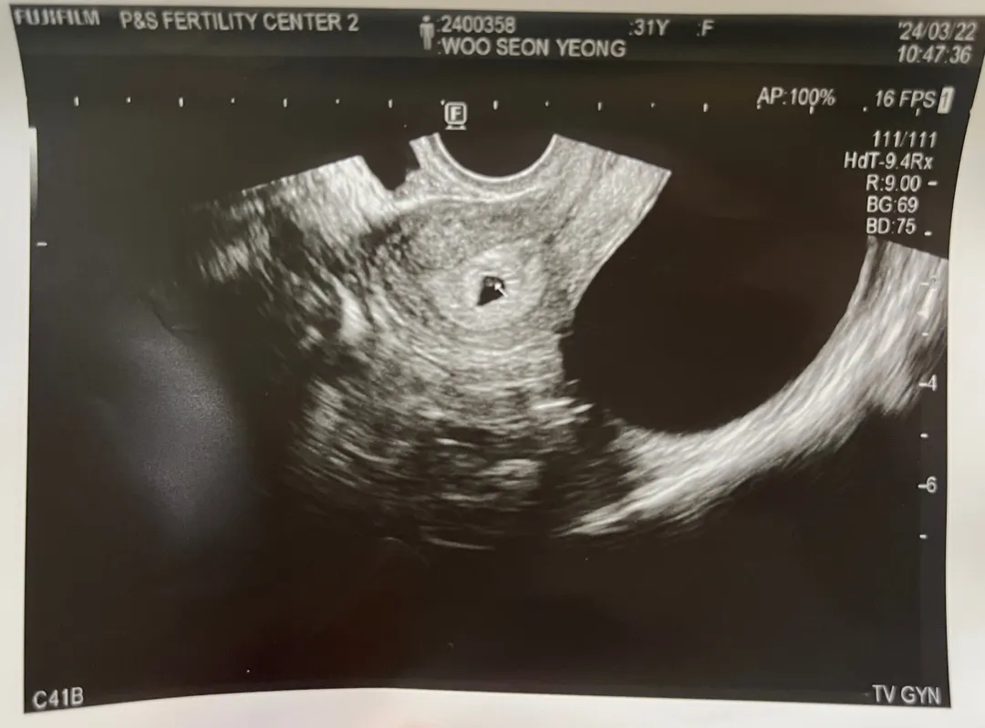 5주1일차 오늘 애기집보고왔어요❤︎