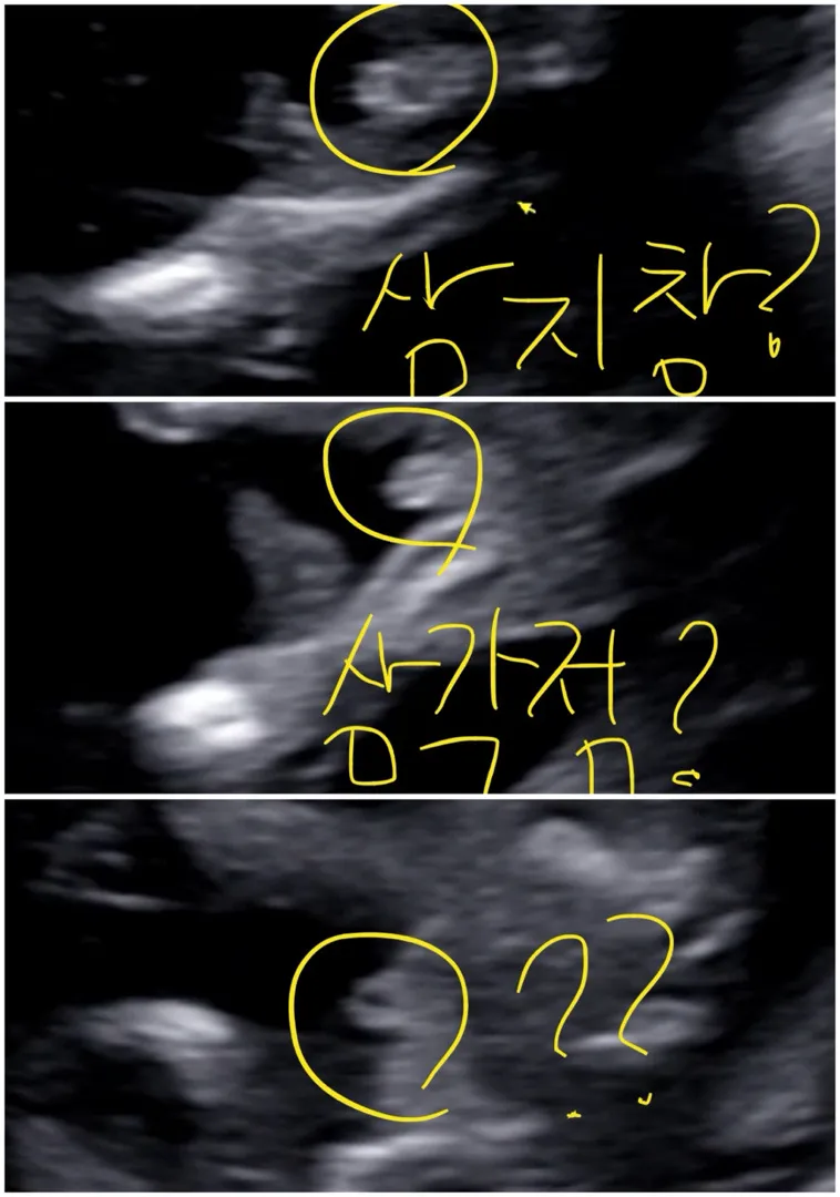 18주차 저처럼 아직도 성별 애매한 애기 있나요?