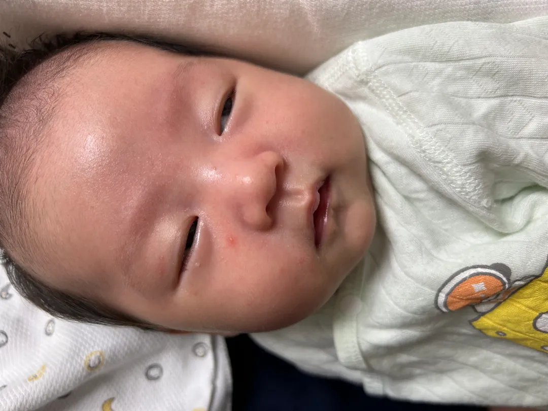 분유 변경 얼굴 뾰루지??
